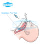 Endotracheal Tube Secretions Pool